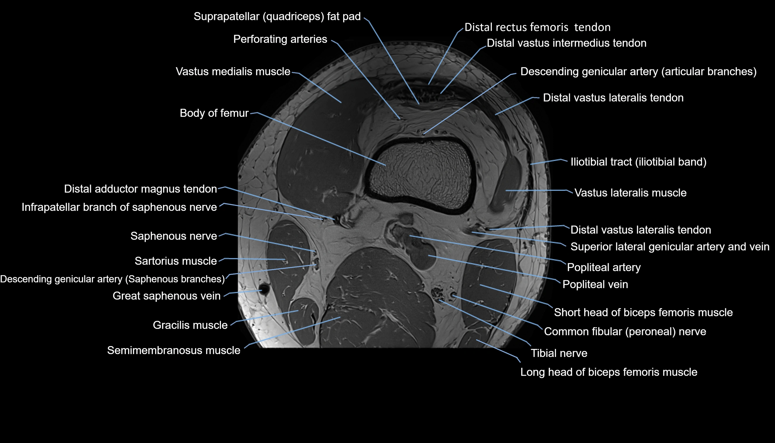 MRI knee  axial cross sectional anatomy 3T radiology  image-img-00001-00003.webp